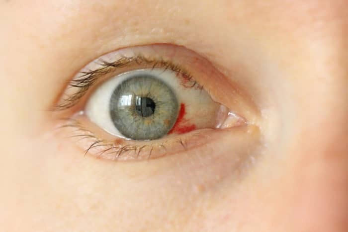 Bloodshot eye. 