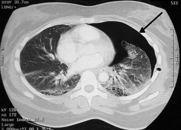 CT of a pneumothorax.